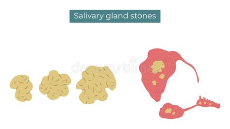 Stones In The Parotid Submandibular And Sublingual Salivary Glands