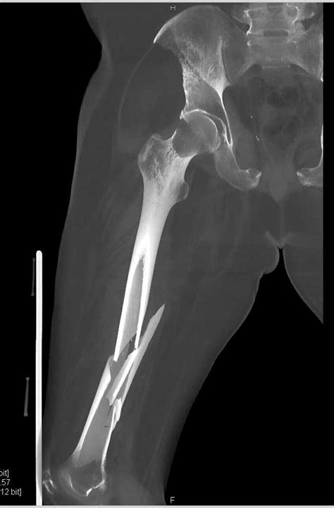 Spiral Fracture Of The Femur Musculoskeletal Case Studies Ctisus Ct