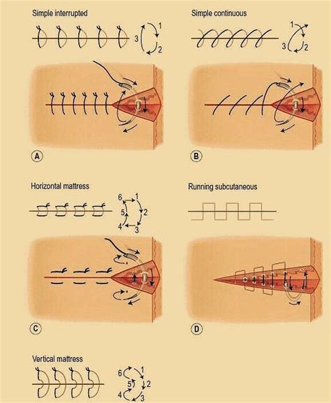 Useful Diagram Different Types Of Surgical Suture Doctor Medicine