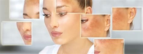 Hyperpigmentation Treatments Types Causes And How To Treat