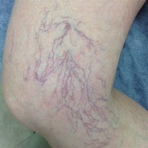 What Are Spider Veins — The Leg Vein Doctor Brisbane Varicose And Spider Vein Phlebology Clinic