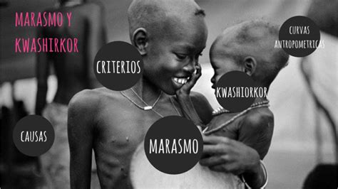 Marasmo Y Kwashiorkor By Gabriela Vera España
