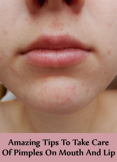 7 Amazing Tips To Take Care Of Pimples On Mouth And Lips Pimplesonchin