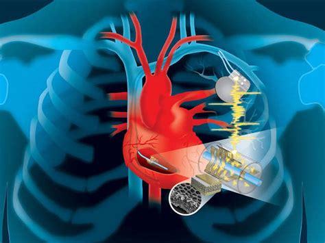 Medical Marvel A New Device Will Use Hearts Energy To Power