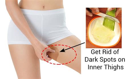 People who are obese are more prone to inner thigh rashes due to constant skin chaffing while running or walking. How to Lighten Your Dark Inner Thighs Naturally - Page 2 ...
