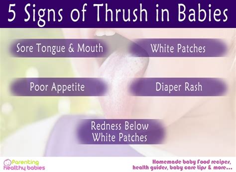 5 Signs Of Thrush In Babies