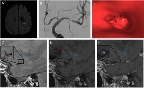 Figure 1 From Isolated Middle Cerebral Artery Dissection With