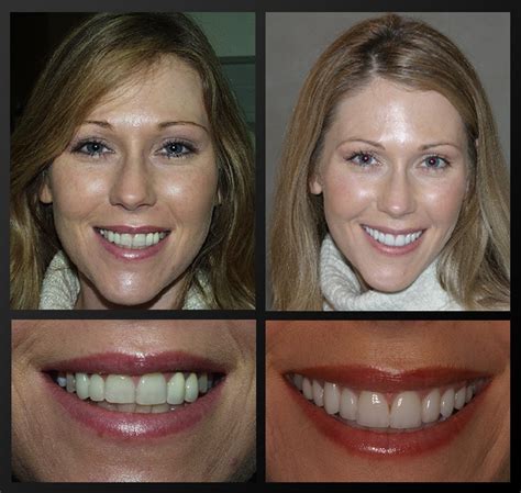 Crooked Teeth Veneers Before And After Teethwalls