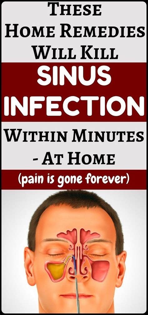 How To Treat Sinus Infection With Natural Remedies Sinusitis Sinus