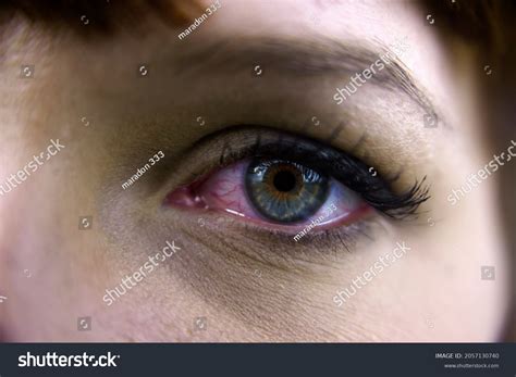 Young Woman Burst Blood Vessel Eye Stock Photo 2057130740 Shutterstock