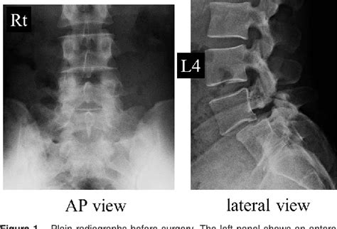 Figure 1 From Successful Endoscopic Surgery For L5 Radiculopathy Caused