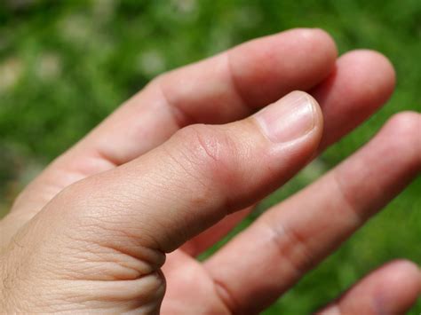 How To Tell If Your Finger Is Broken Sprained Or Jammed