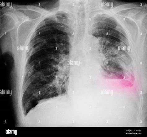 Chest Xray Of Lung Cancer In A Man Stock Photo More
