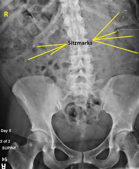 Constipation Abdominal X Ray Wikidoc