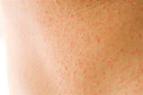 Skin Welt Stock Photos Pictures And Royalty Free Images Istock