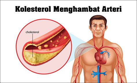 Kolesterol adalah metabolit yang mengandung lemak sterol (bahasa inggris: Mengobati Kolesterol Tinggi dengan Herbal | Pirostore