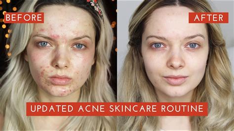 Updated Acne Skincare Routine How I Cleared My Acne Mypaleskin