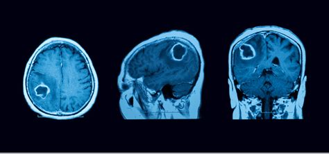 Understanding Brain Tumor Tremors Causes And Symptoms Cala Health