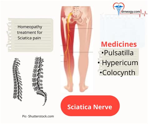 Treatment For Sciatica Pain Dr Neogy