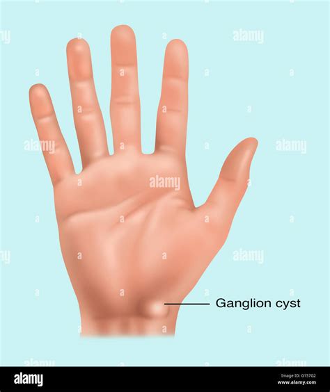 Ganglion Cyst Wrist Pain