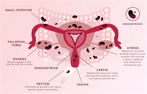 Exactly What Endometriosis Does To Your Reproductive System Healthmedicinentral