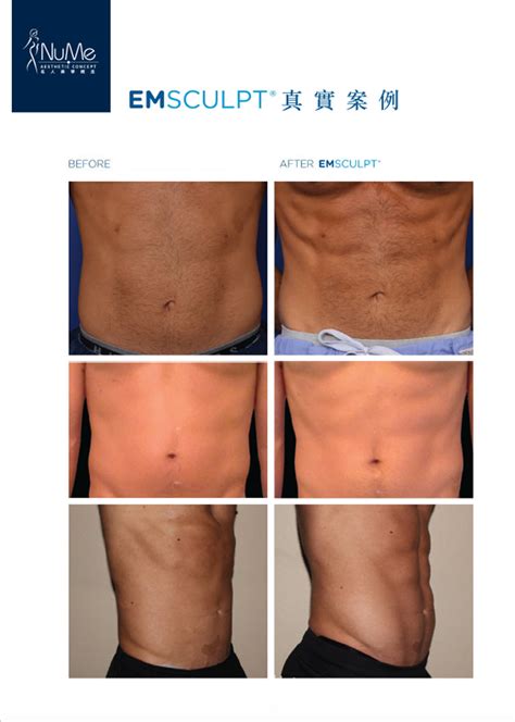 Emsculpt Fda Approved Body Sculpting And Muscle Building Nume