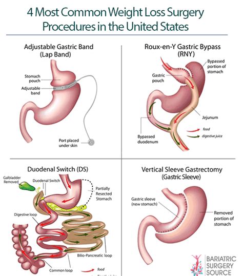 Bariatric Surgery What To Know