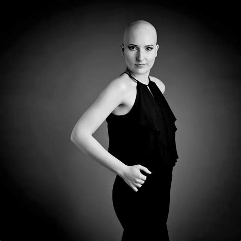 Alopecia areata is one type of hair loss that typically causes patches of baldness. Alopecia areata - Hannah - Beate Knappe