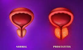 Causes Symptoms And Treatment Of Prostatitis Top Urologist Nyc