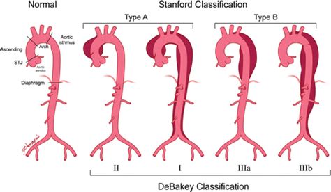 Aortic Dissection Cross Section