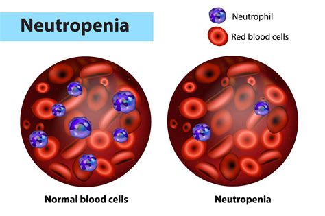 What Is Absolute Neutrophil Count Anc And How Is It Measured In Blood