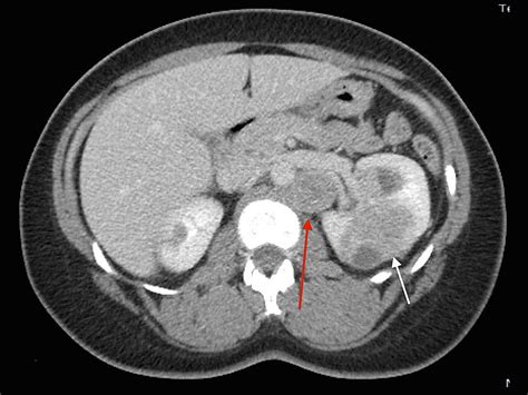 Simple Ct Scan Eliminates Need For Surgery In Kidney Cancer