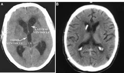 Intracranial Hypertension Cancer Therapy Advisor