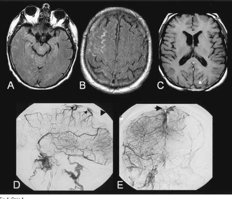 Figure 1 From Subarachnoid Hemorrhage As The Initial Presentation Of