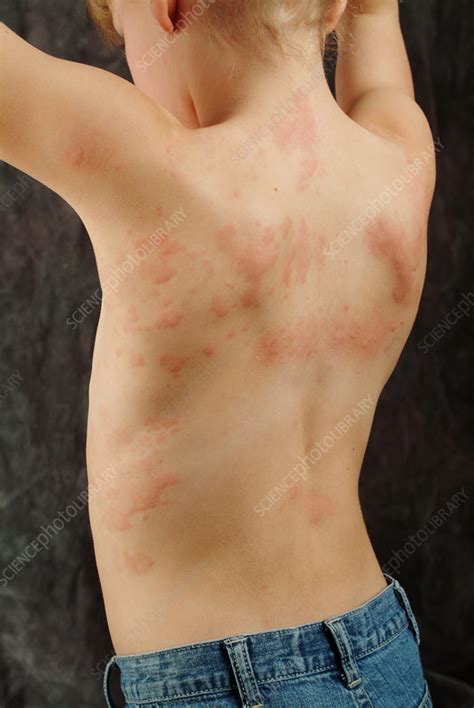Hives Stock Image C0221887 Science Photo Library