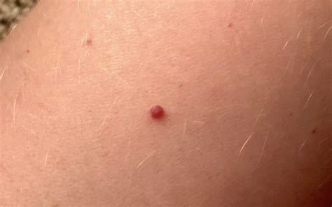 What Are Cherry Angiomas — And How Do You Get Rid Of Them