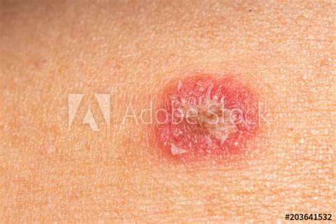 Check spelling or type a new query. "Ring Worm infection, Dermatophytosis on skin" Stock photo and royalty-free images on Fotolia ...