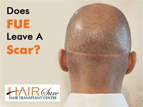 Best Fue Hair Transplant In Hyderabad Cyber Hairsure