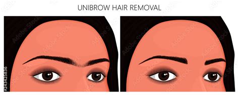 Vector Illustration Unibrow On Womans Face Before After Excess Hair