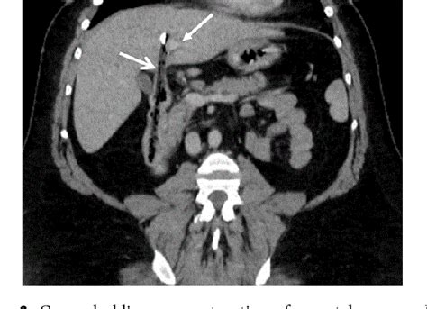 Figure From A Case Report Of The Retrieval Of A Duodenal Foreign Body