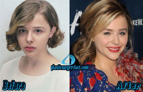 Chloe Moretz Lip Injections