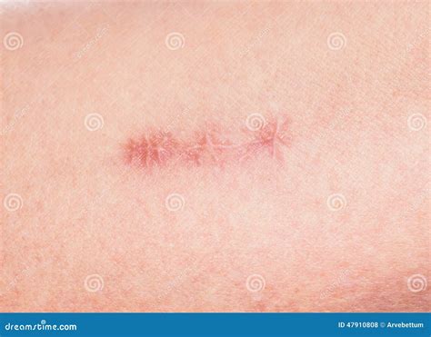 Redness Around Healing Stitches On Skin Stock Photo Image Of Damage