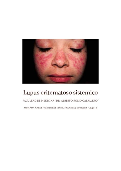Doc Lupus Eritematoso Sistemico Denisse Miranda Cardenas