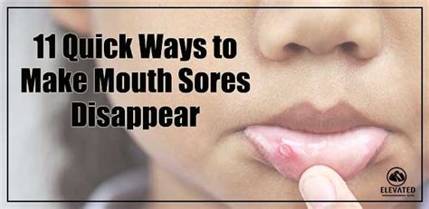 11 Quick Ways To Make Mouth Sores Disappear Elevated Dental