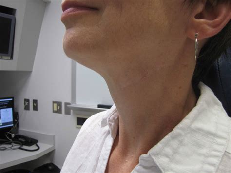 Case Example Submandibular Gland Resection Iowa Head And Neck Protocols