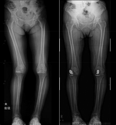 Bilateral Unicompartmental Knee Arthroplasty For Windswept Knee Osteoarthritis A Report Of