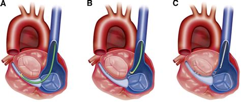 A Novel Method Of Percutaneous Mitral Valve Repair For Ischemic Mitral