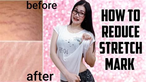 How To Reduce Stretch Mark Home Remedies Youtube