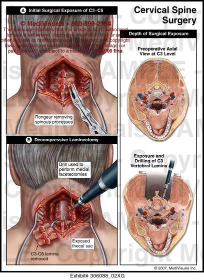 Posterior Cervical Spine Surgery