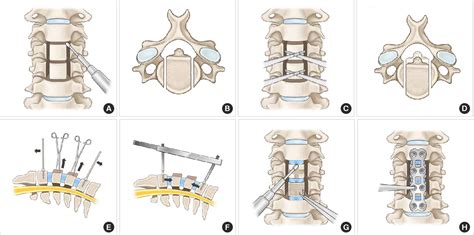 Figure 3 From Vertebral Body Sliding Osteotomy For Cervical Myelopathy